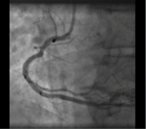 angiography after