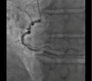 angiography before