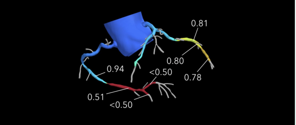 heart flow analysis