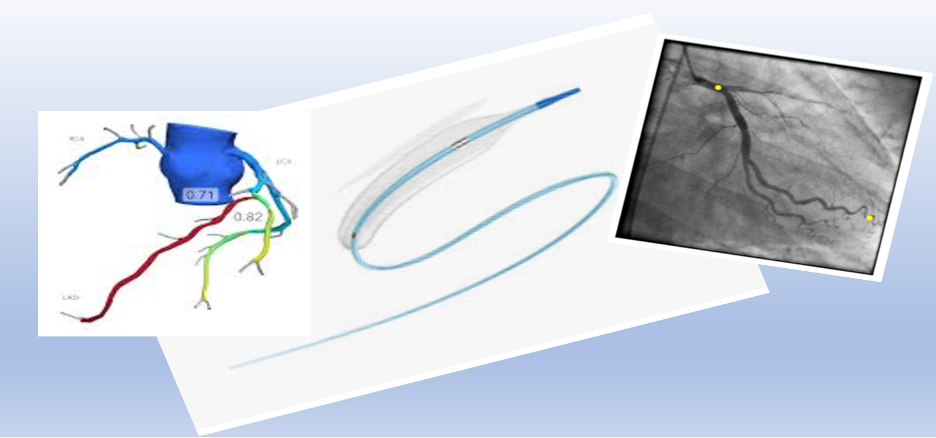 What Impact is CCTA having on Coronary Interventions?