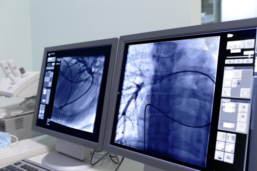 Coronary Calcium Scan